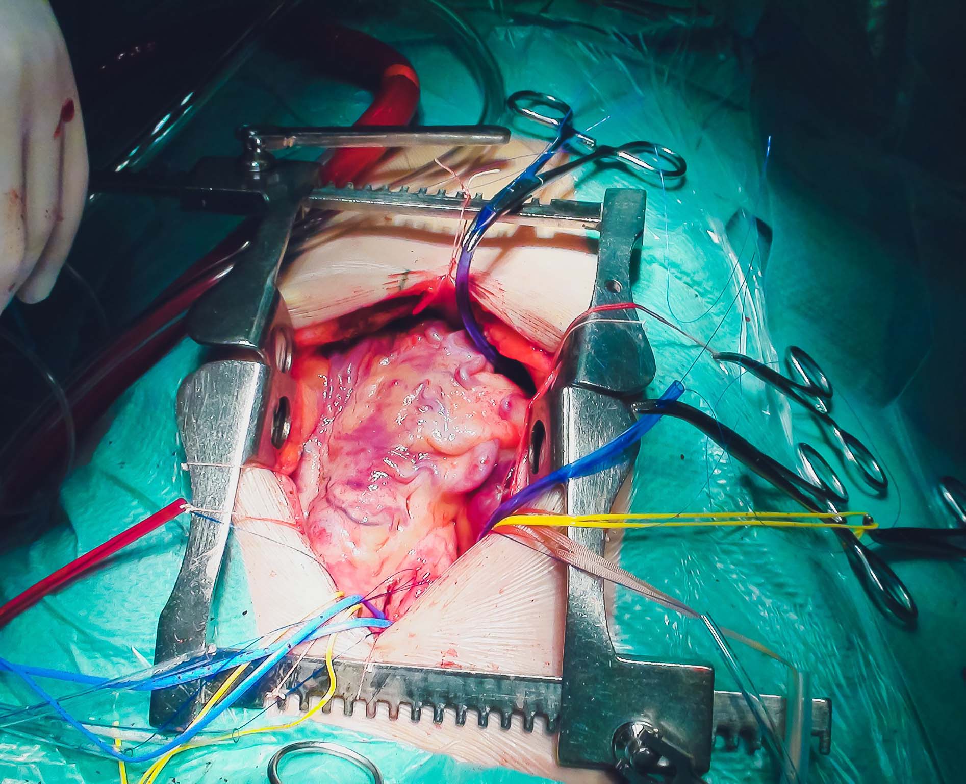 Percutaneous Coronary Intervention (PCI)