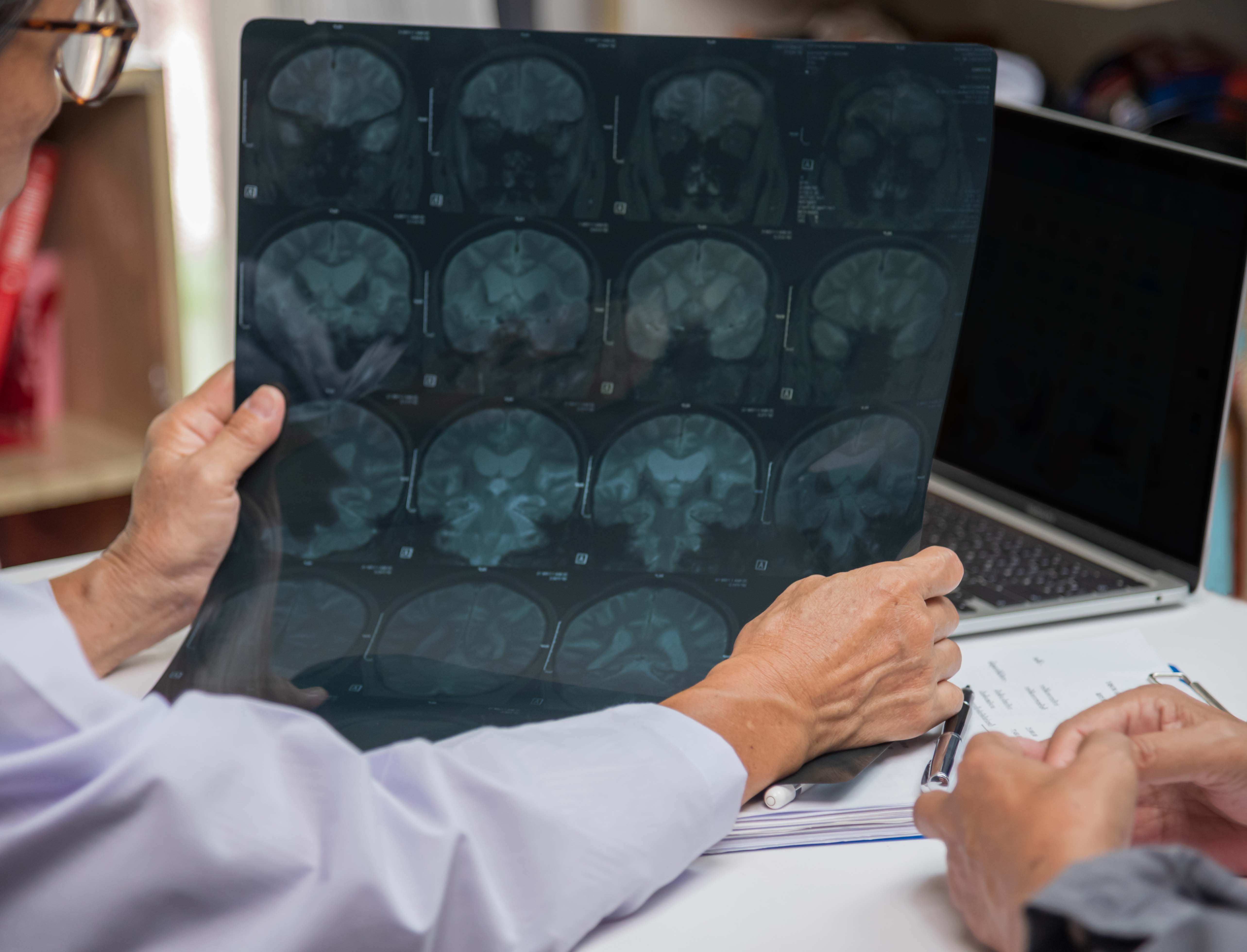 Multiple Sclerosis